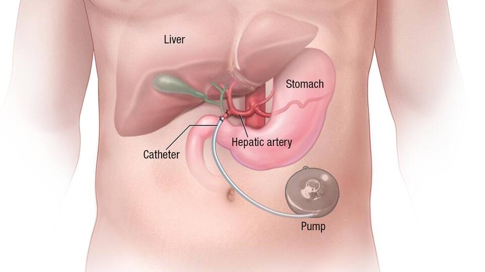 Hepatic artery infusion pump therapy - HAIP medical illustration