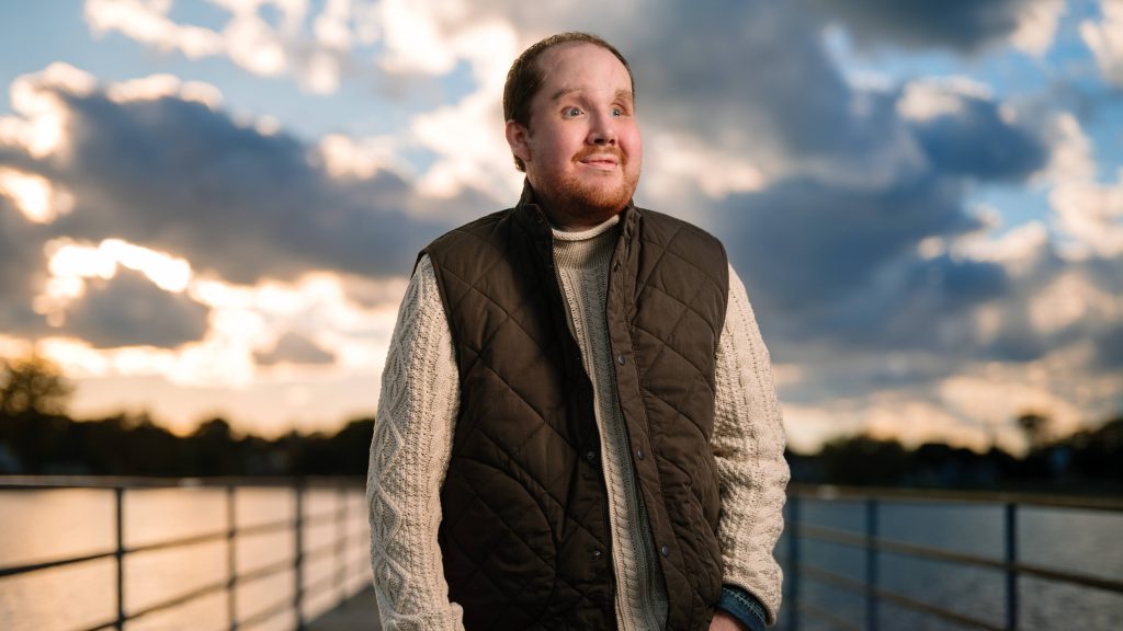 Man standing at pier after his face transplant