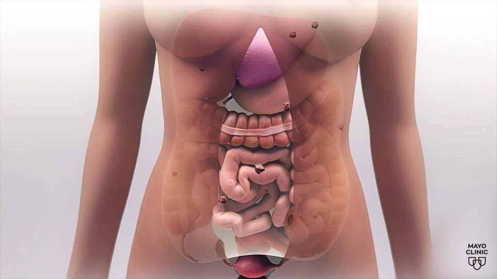 medical illustration of stomach cancer