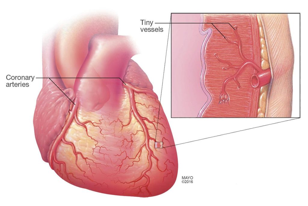 View of a heart with coronary artery disease or coronary microvascular disease. An inset highlights the clogging and narrowing of the arteries.