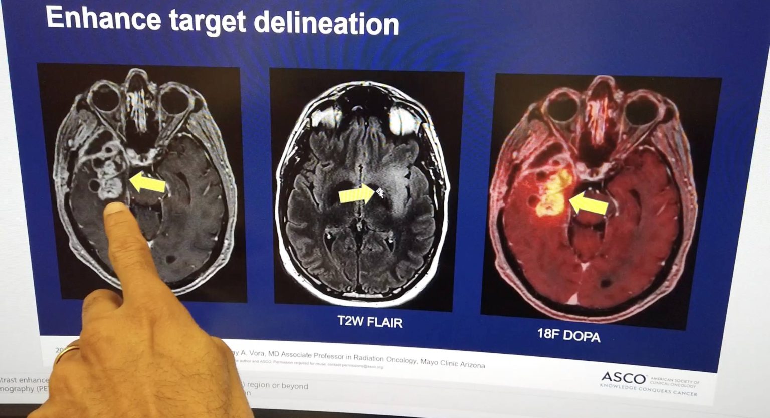 Breakthrough in Treatment Approach Showing Promise in the Fight Against Glioblastoma, the Deadliest and Most Aggressive Type of Brain Cancer