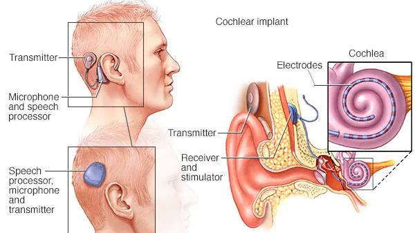 Mayo Clinic medical illustrtion of how cochear implants work