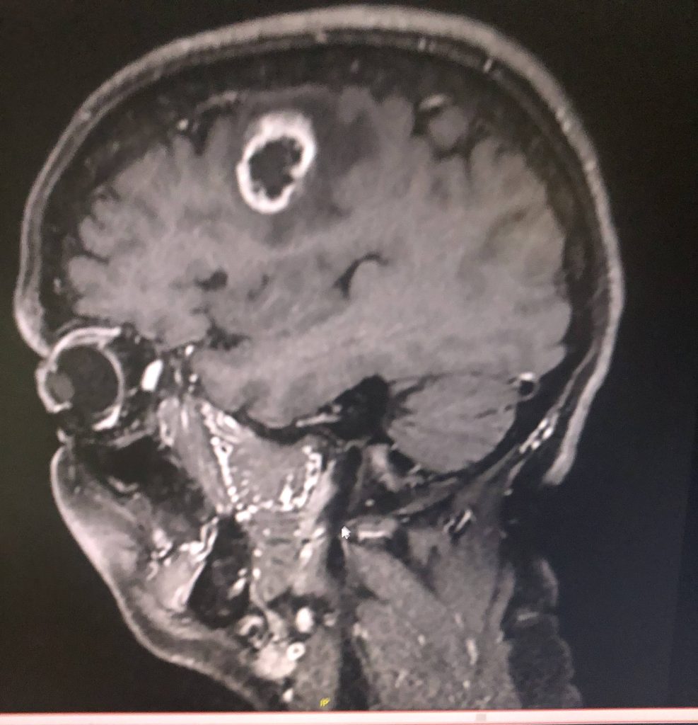 Symptoms of glioblastoma