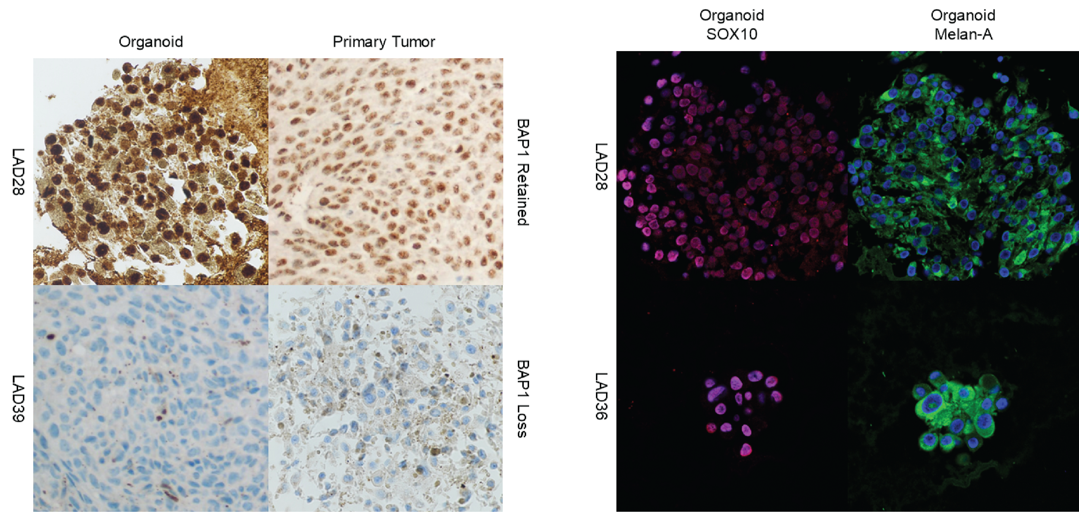 The first image shows histopathological comparisons of uveal melanoma organoids and their tumors of origin under the microscope. 

The second image shows uveal melanoma organoids characterized by immunofluorescence  to demonstrate that both are derived from the same part of the eye. 