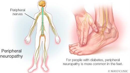 a medical illustration of peripheral neuropathy