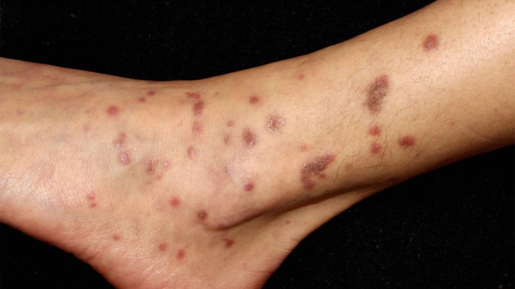 Photo of ankle and leg with skin disease, lichen planus