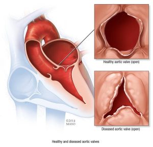 Illustration of healthy and diseased aortic valves