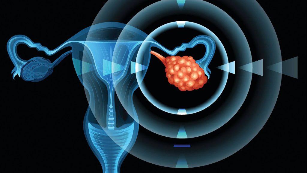 Ovarian cancer illustration