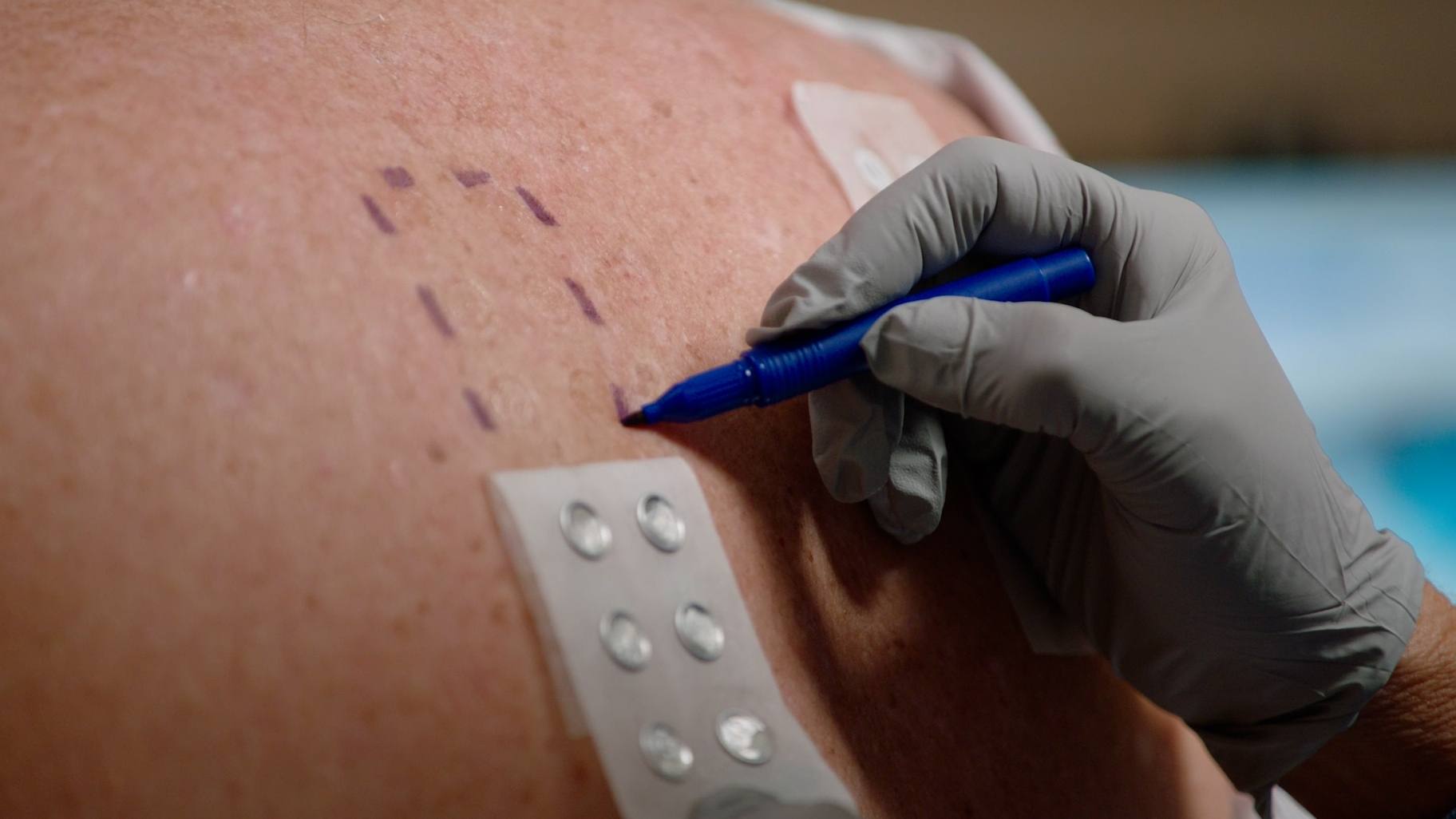 Skin or patch test, skin allergies