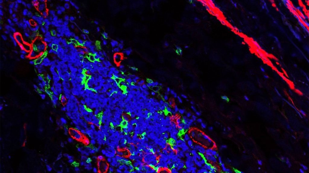 Immunofluorescent image of immune cells in tissues affected by giant cell arteritis.