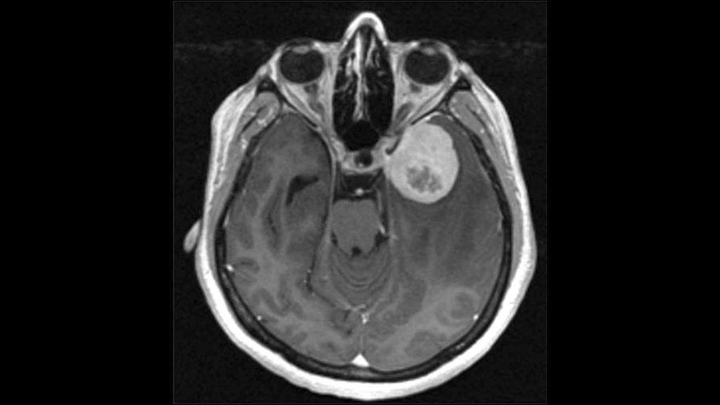 Black and white brain scan image of a meningioma