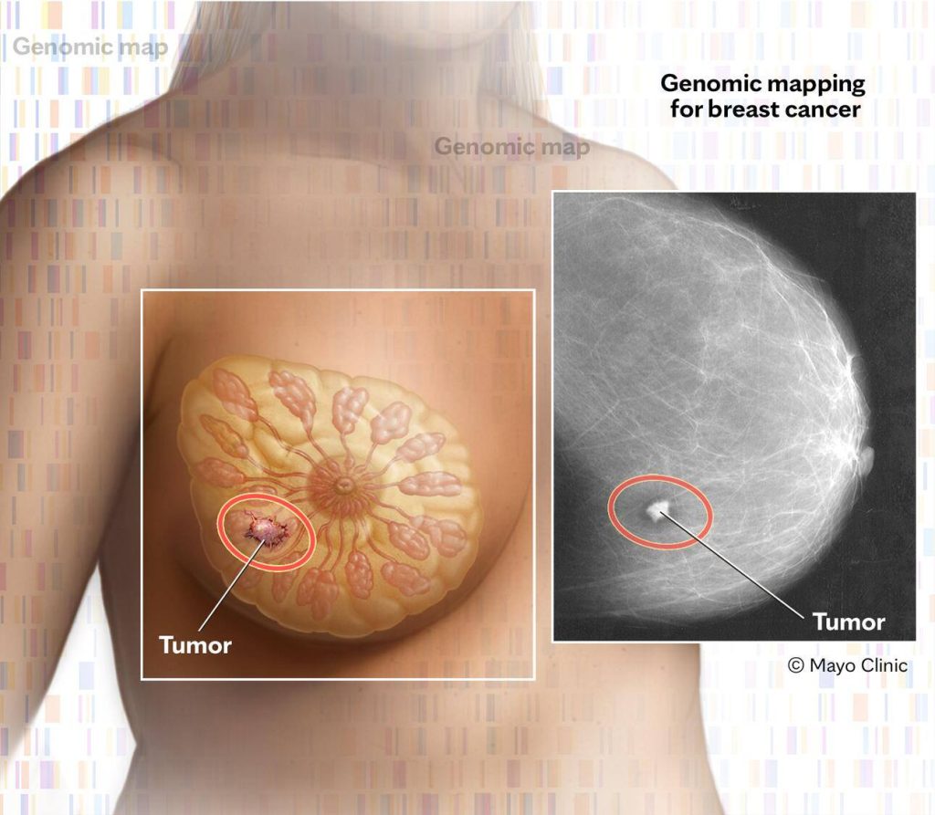 Medical illustration of genomic mapping for breast cancer