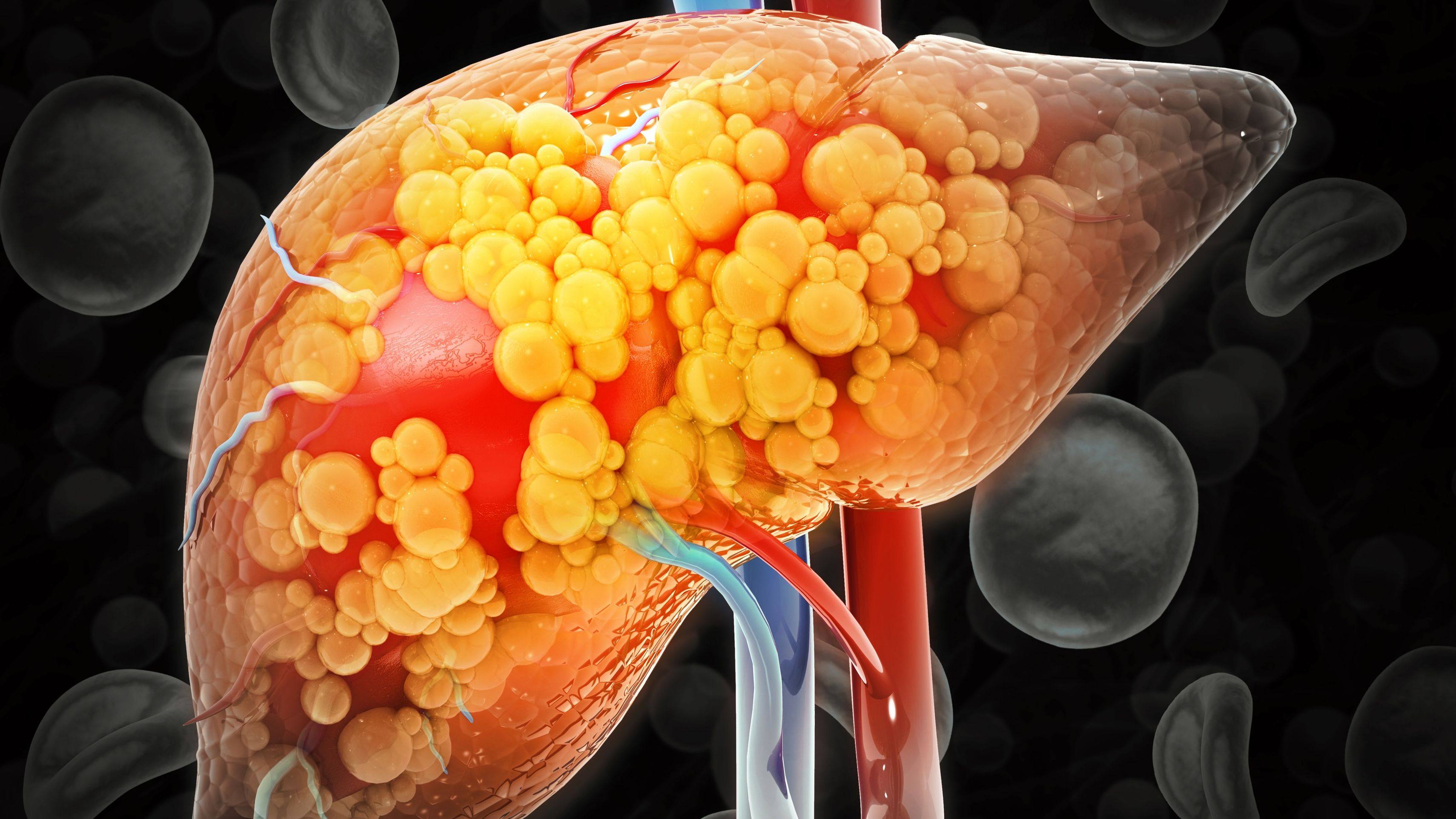 New study links genetic variation to chemotherapy-related liver damage in patients with colorectal cancer liver metastases featured image
