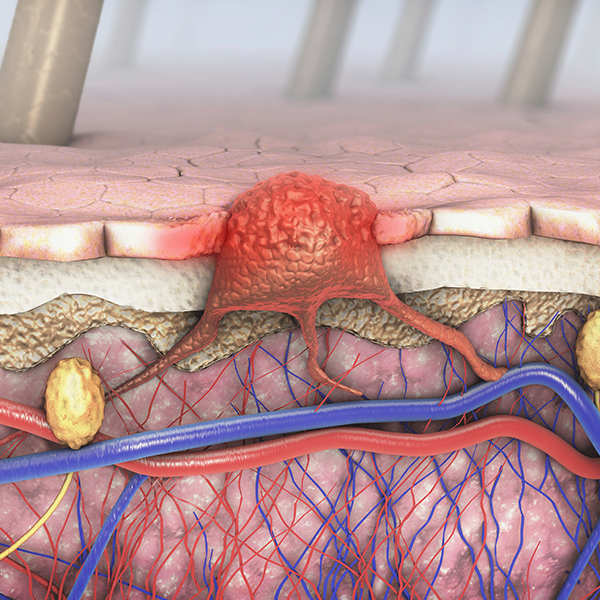 New genomic test could spare some people with melanoma from lymph node biopsy surgery  featured image