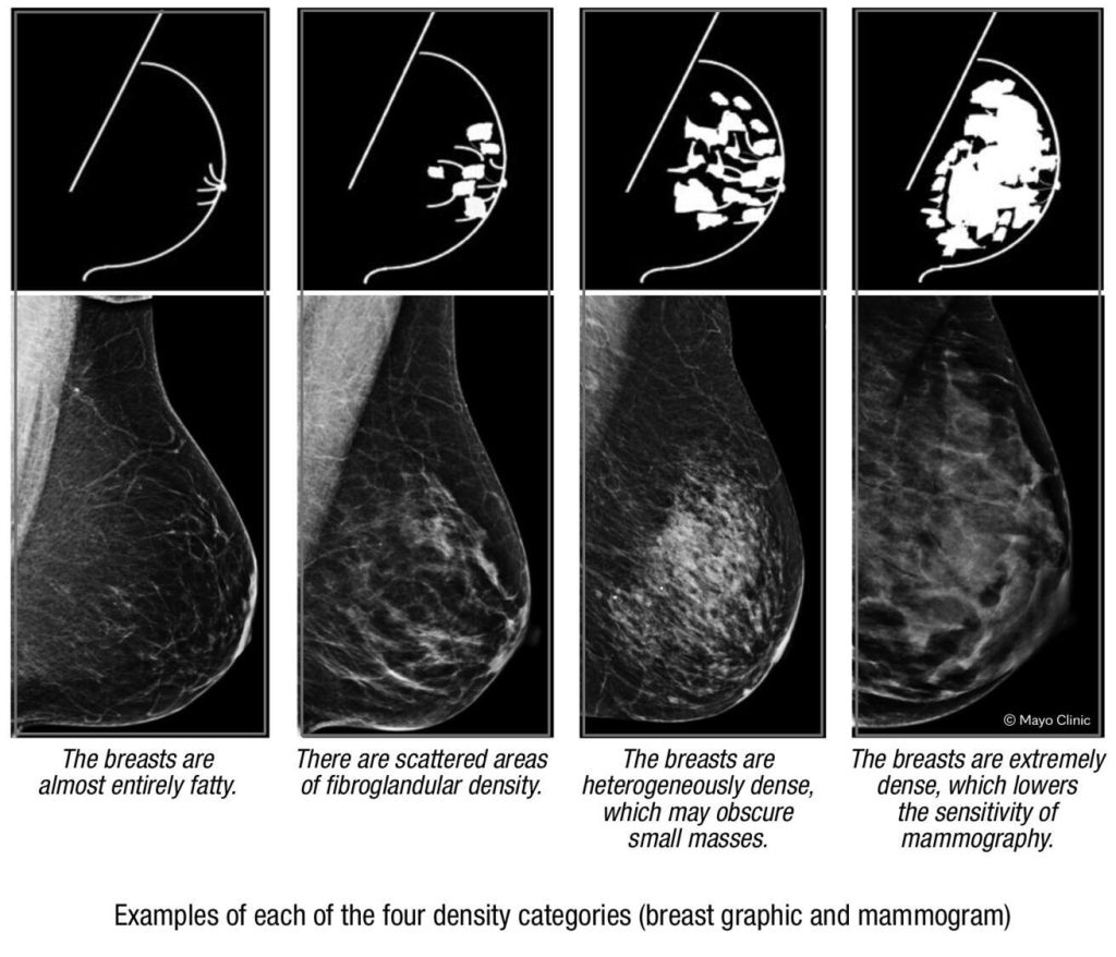 Examples of each of the four breast density categories.