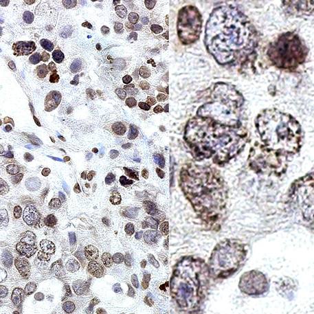 Mayo Clinic uncovers hidden driver fueling aggressive prostate cancer  featured image