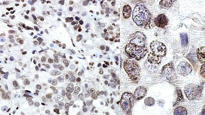 Medical illustration: Prostate cancer-tumor tissue with soluble nucleoporins