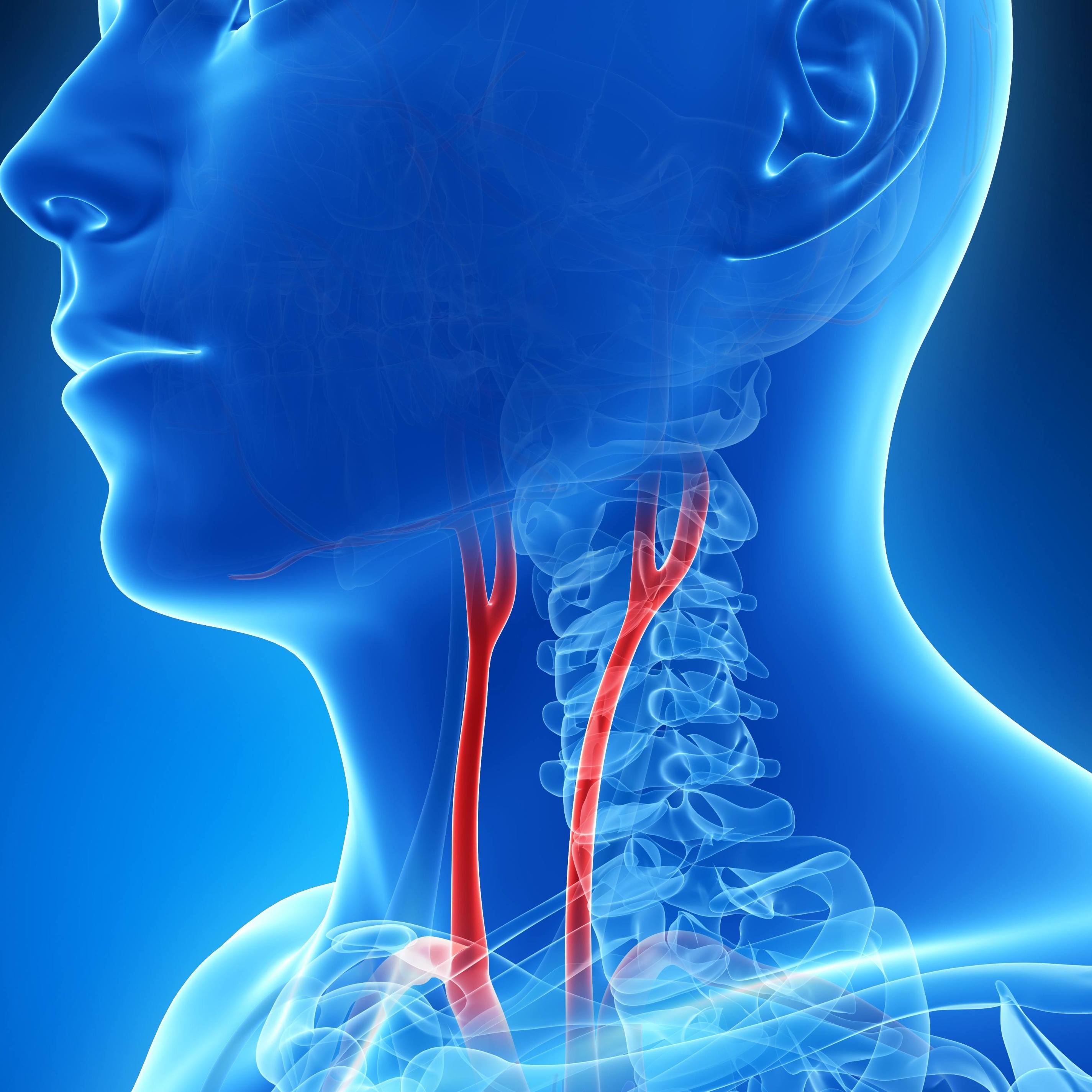 Landmark Mayo Clinic study finds stenting reduces stroke risk in people with carotid artery narrowing featured image