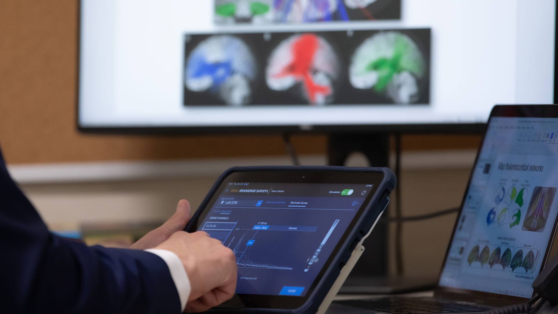Mayo Clinic physicians map patients’ brain waves to personalize epilepsy treatment featured image