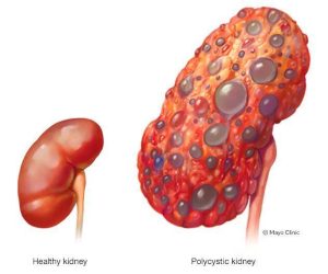 Illustration of a healthy kidney and a polycystic kidney