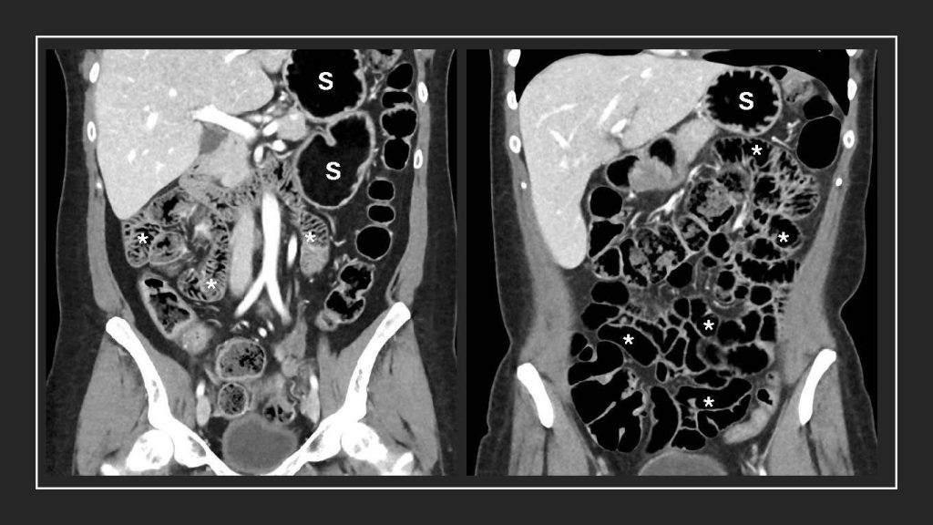 CT images from a patient who ingested the new oral solution that better distends the stomach (see the white S) and small bowel (asterisks) so that enhancing pathologies inside and outside the bowel wall can be better displayed and detected by radiologists.