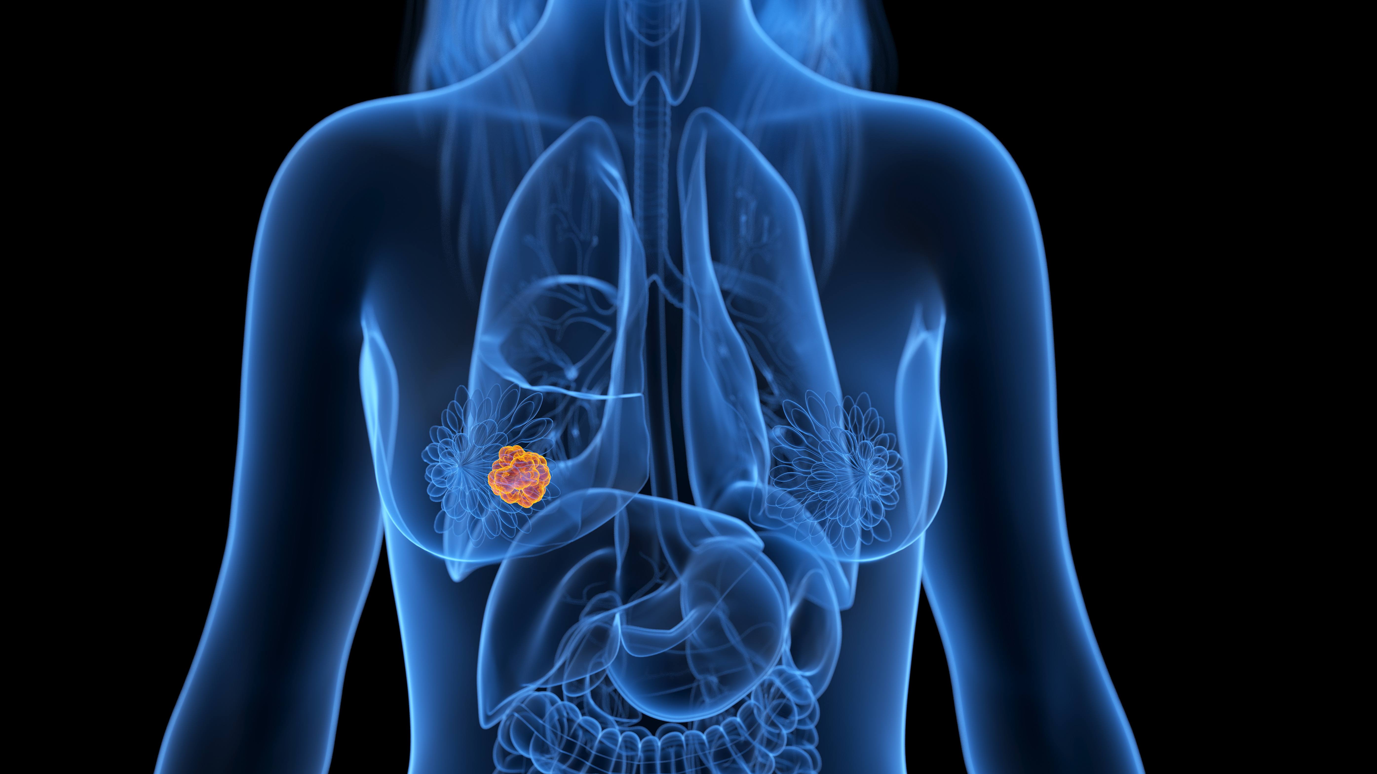 From fear to a phone call in 2 hours, breast cancer patient gets care faster with the help of intelligent automation featured image