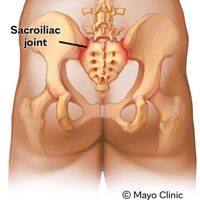 Mayo Clinic Q&A: Can surgery alleviate sacroiliac joint pain and issues? featured image