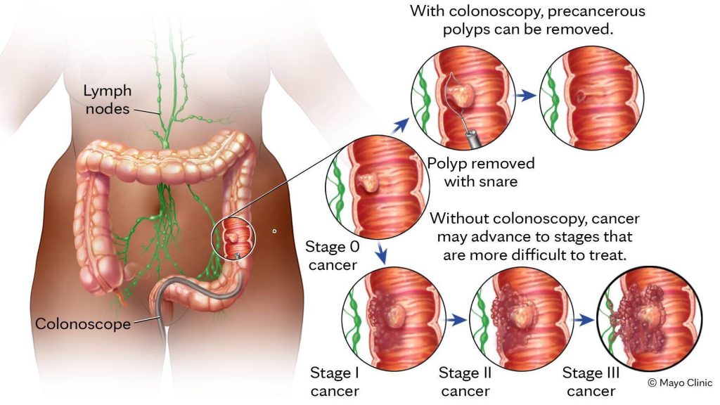 Medical illustration of colon polyps, colorectal cancer stages