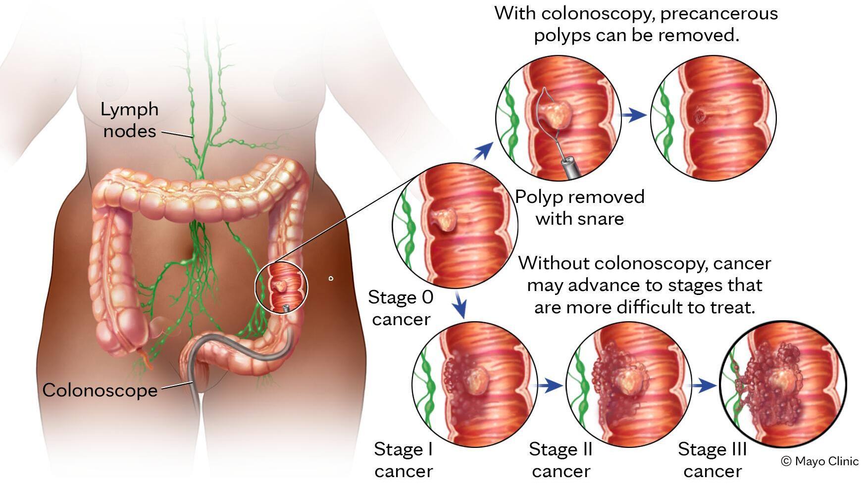 “Cutting-Edge AI Tech Aids in Detecting Hidden Colon Polyps for Better Patient Care”