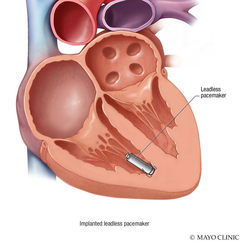 Medical illlustrastion, implanted leadless pacemaker