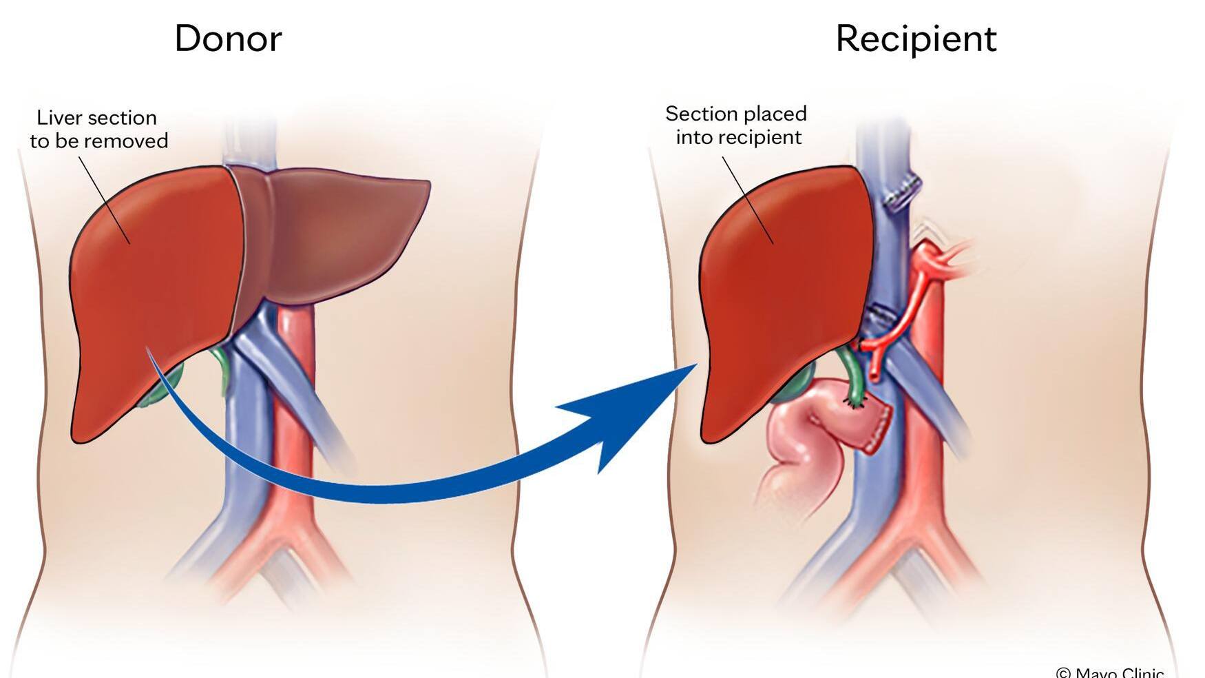 Liver transplant illustration