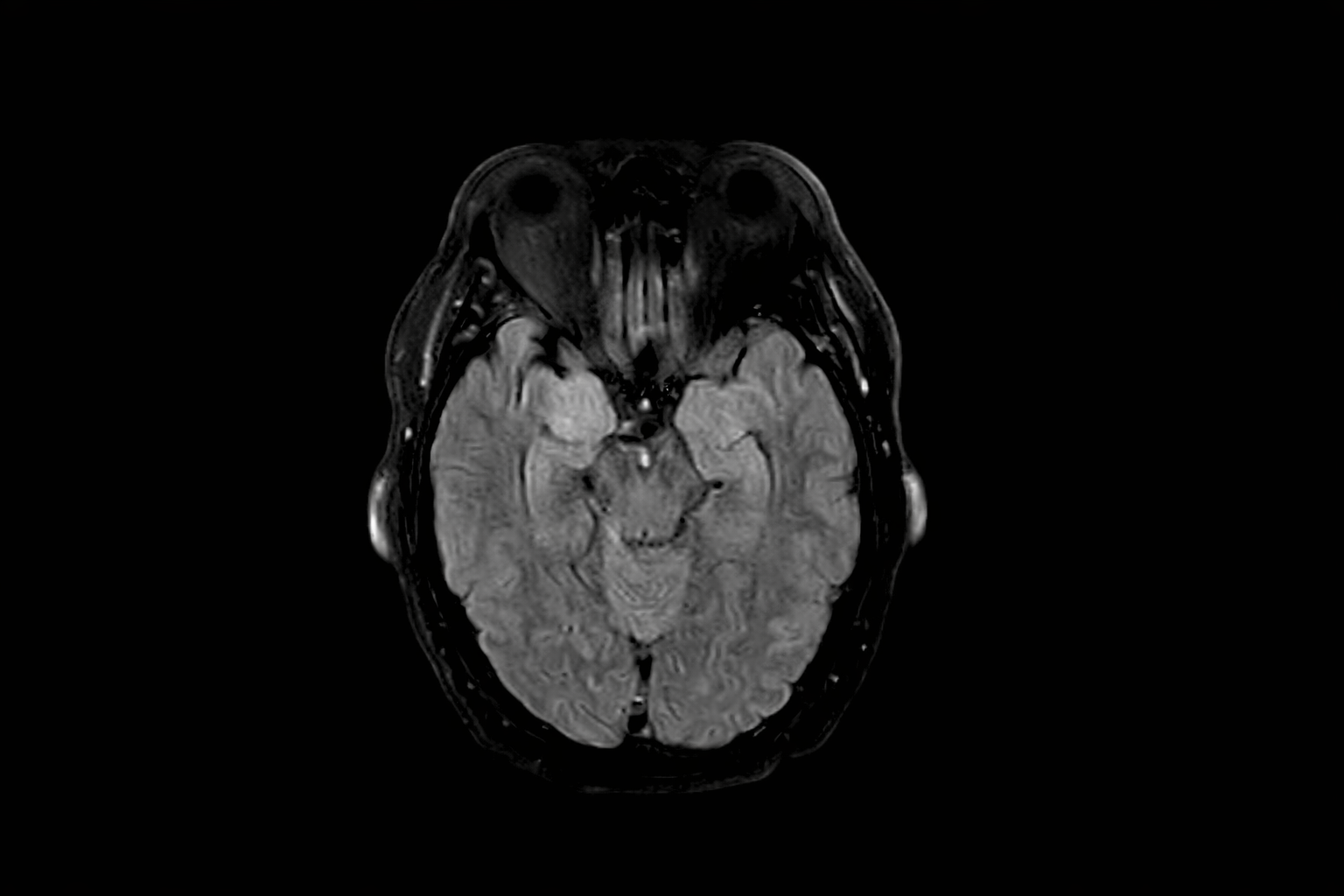 When the immune system attacks the brain: recognizing and treating a life-threatening condition featured image