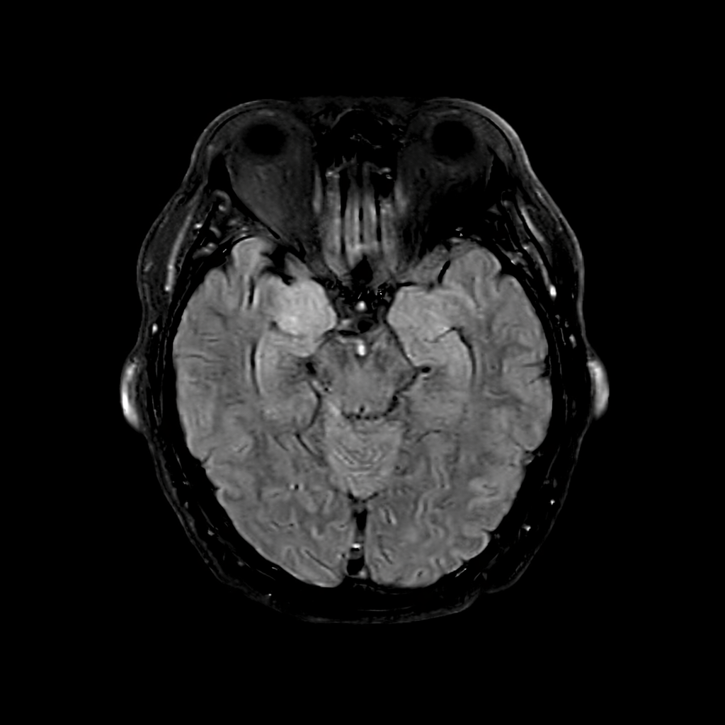 When the immune system attacks the brain: recognizing and treating a life-threatening condition featured image