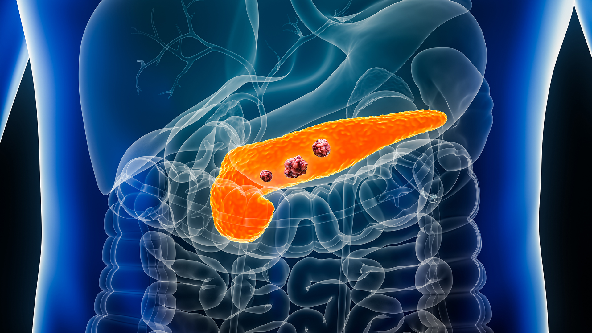 Mayo Clinic AI detects pancreatic cancer up to 3 years before diagnosis in landmark validation study featured image