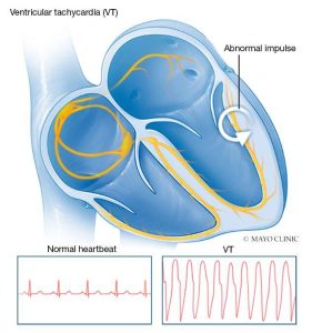Heart with ventricular tachycardia (VT), an abnormal heart rhythm (arrhythmia). Abnormal impulse is shown. Graphs show normal heartbeat and VT.