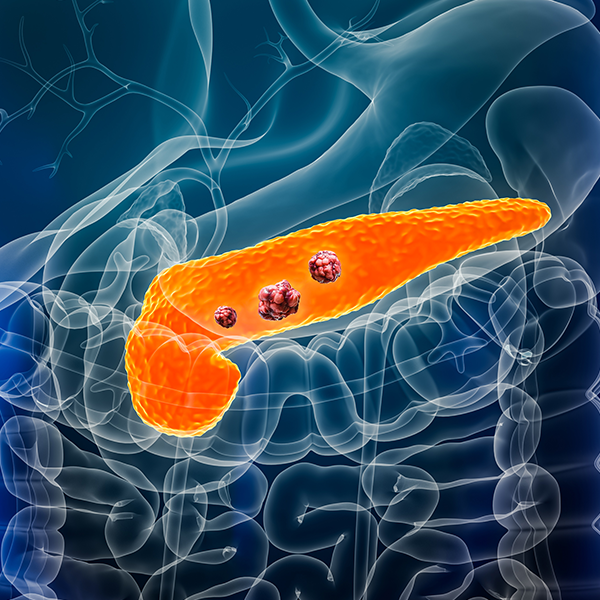 Mayo Clinic AI detects pancreatic cancer up to 3 years before diagnosis in landmark validation study featured image