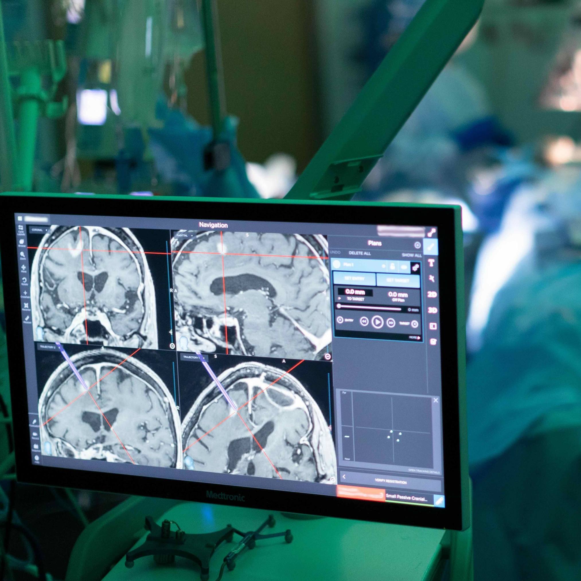 Mayo Clinic Q&A: Understanding minimally invasive brain tumor treatment options featured image
