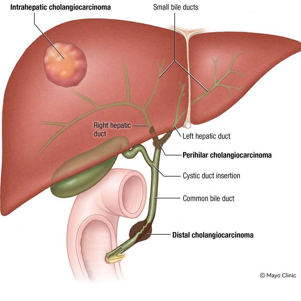 Types of cholangiocarcinoma. Cholangiocarcinoma is a type of cancer that forms in the slender tubes (bile ducts) that carry the digestive fluid bile