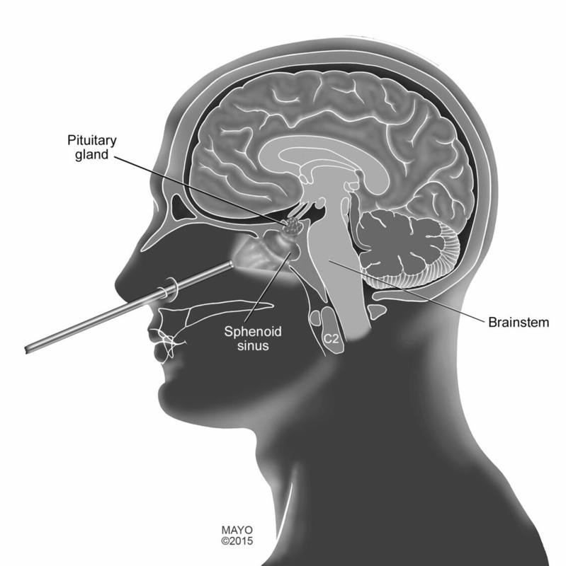 In endoscopic transnasal transsphenoidal surgery, a surgical instrument is placed into the nasal cavity through the nostril to access tumors near the skull base and pituitary gland.