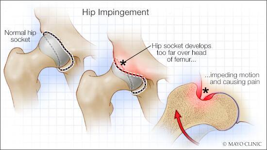 Medical illustration of hip impingement