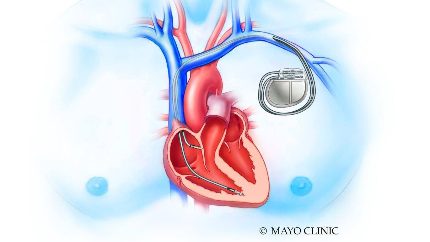 Mayo Clinic Q&A: How is a defibrillator different from a pacemaker? featured image