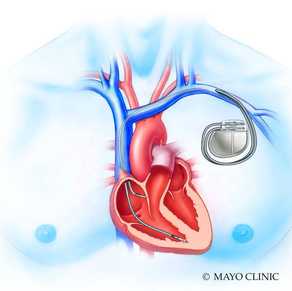Mayo Clinic Q&A: How is a defibrillator different from a pacemaker? featured image