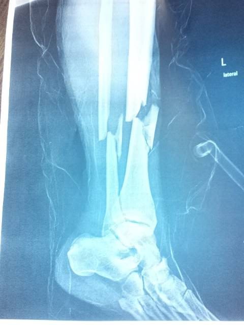 An X-ray shows the severe leg fracture Chad sustained in a 2012 snowmobile accident. Image courtesy of Chad Rockow.