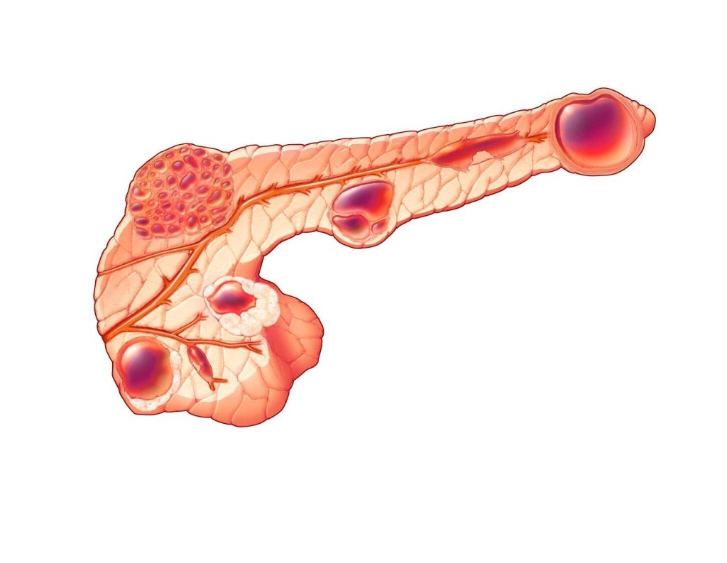 Mucinous cysts in the pancreas