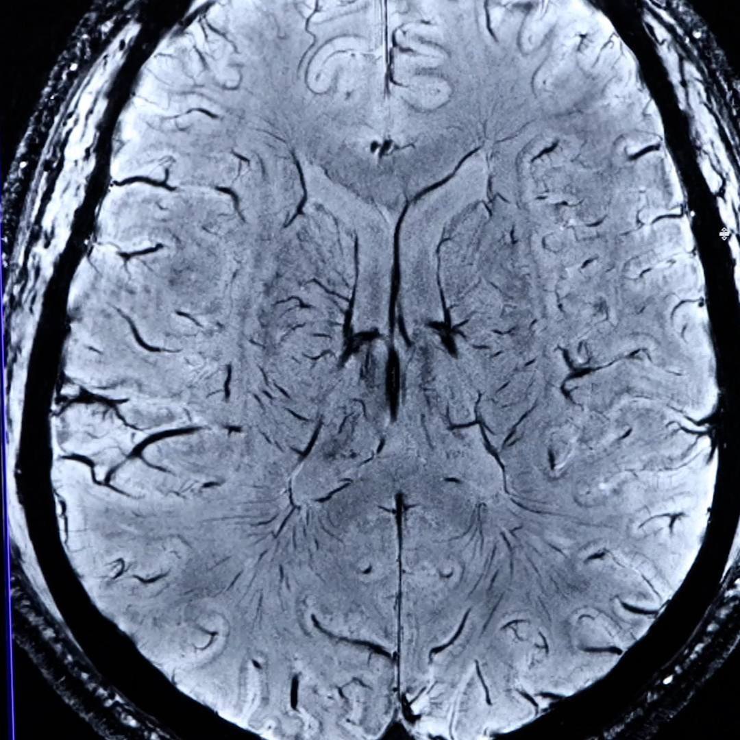 Mayo Clinic Minute: Understanding brain aneurysms and treatment options (VIDEO) featured image