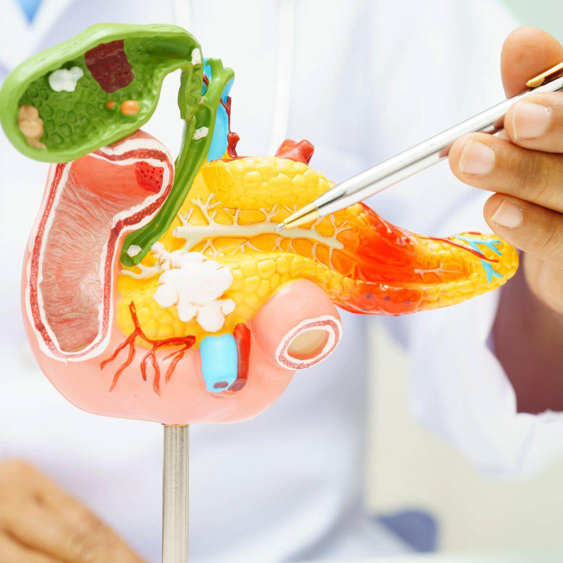 Staging pancreatic cancer early with minimally invasive surgery shows positive results in patient prognosis featured image