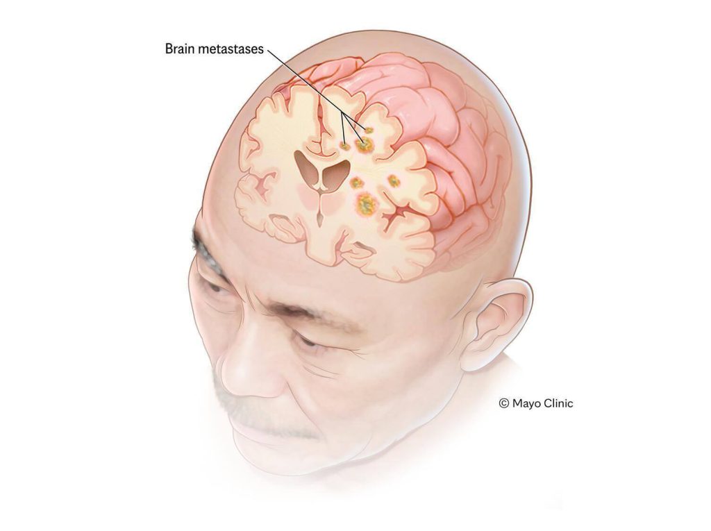Illustrated example of metastases in the brain. Brain metastases happen when cancer begins elsewhere in the body and spreads (metastasizes) to the brain.