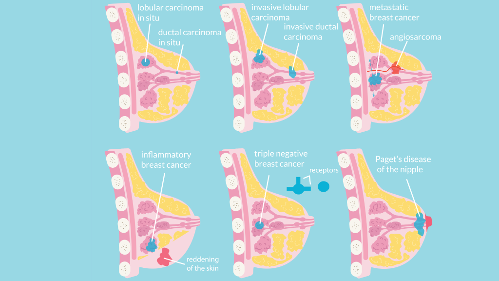 Graphic showing types of breast cancer.