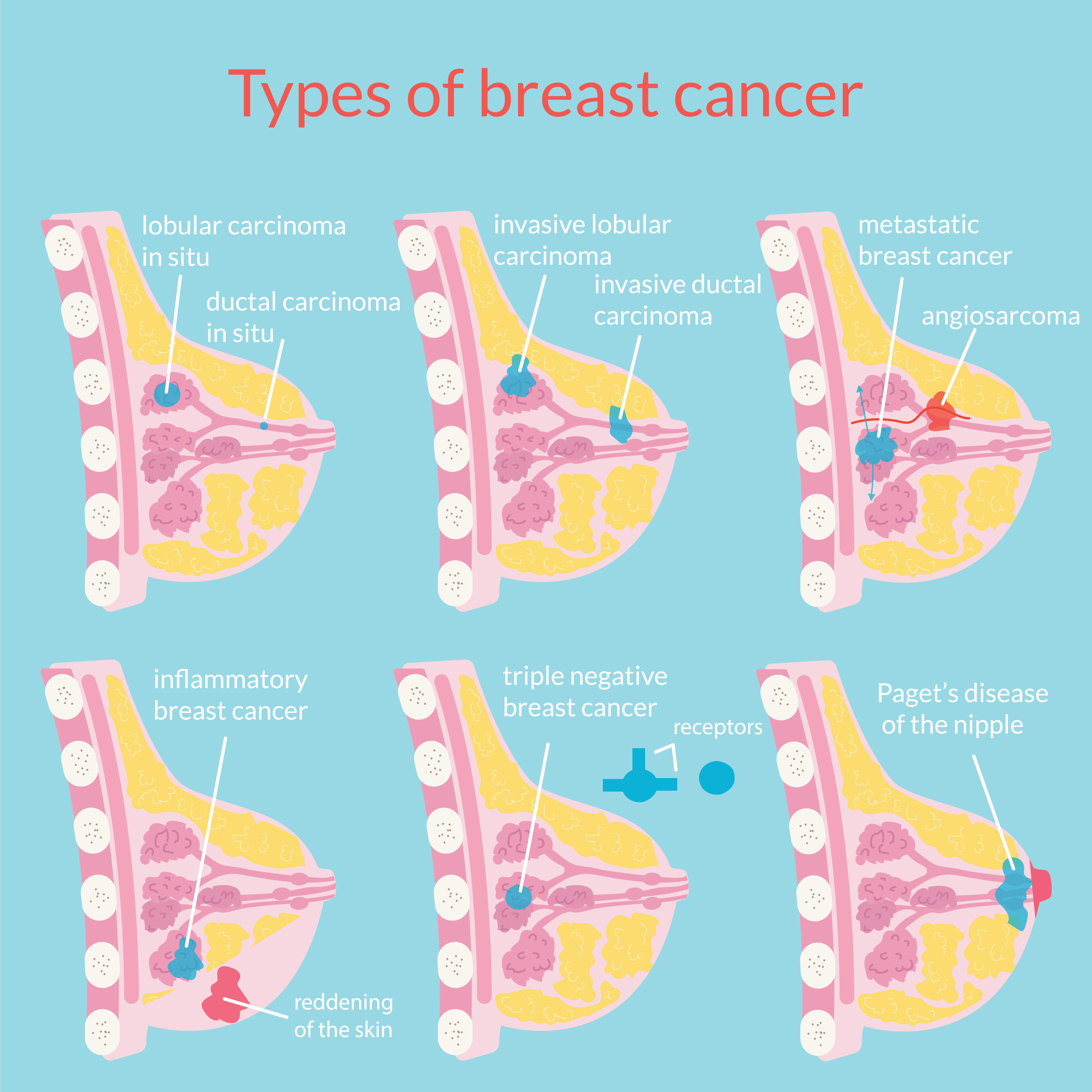 Inflammatory breast cancer: Fast-moving form often lacks lump as warning sign featured image