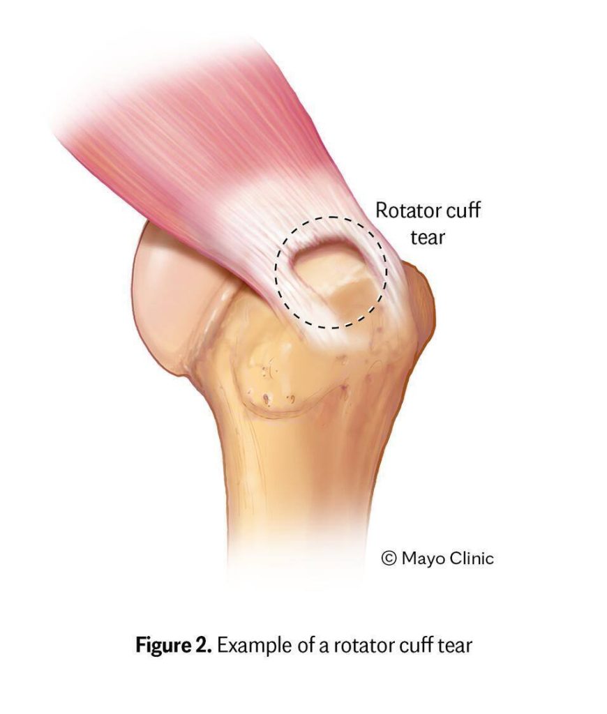 Medical illustration showing a rotator cuff tear